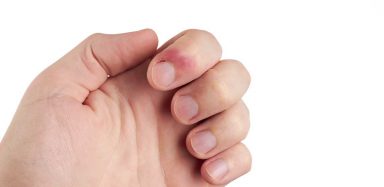 An infected hangnail.